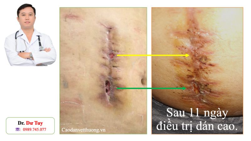 Bài giảng nhiễm trùng vết mổ