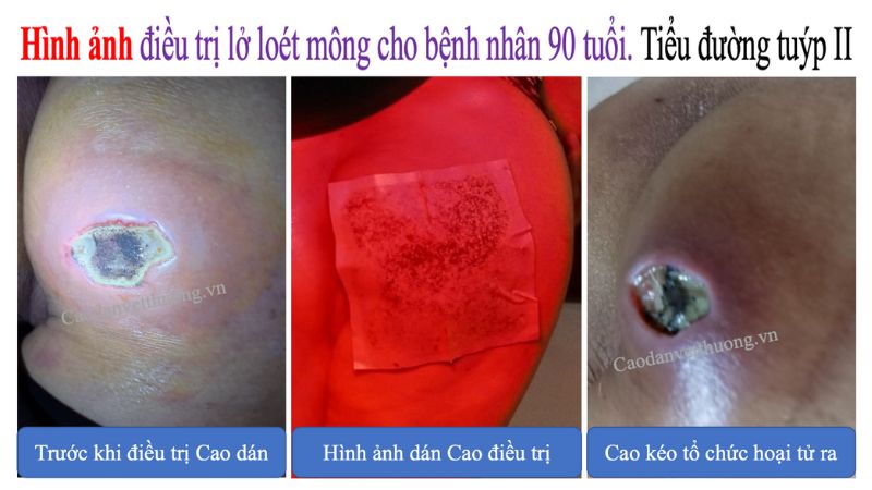 benh-nhan-tieu-duong-tuyp-2-bi-lo-loet-mong12