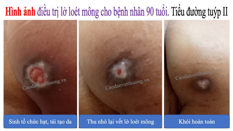 benh-nhan-tieu-duong-tuyp-2-bi-lo-loet-mong14