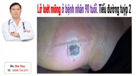 Bệnh nhân tiểu đường tuýp 2 bị lở loét mông