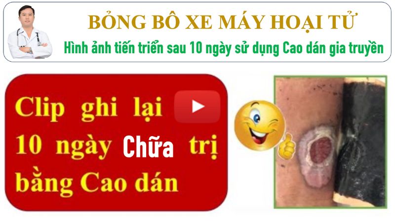 Bị bỏng bô xe máy bôi thuốc gì