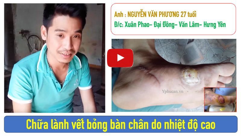 Bị bỏng bôi gì cho nhanh khỏi