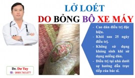 LỞ LOÉT DO BỎNG BÔ XE MÁY