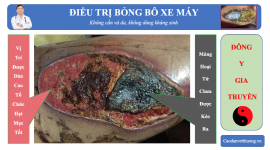 Vết loét do bỏng bô xe máy