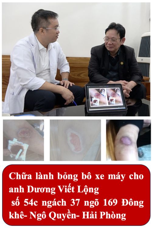 Bỏng bô xe máy