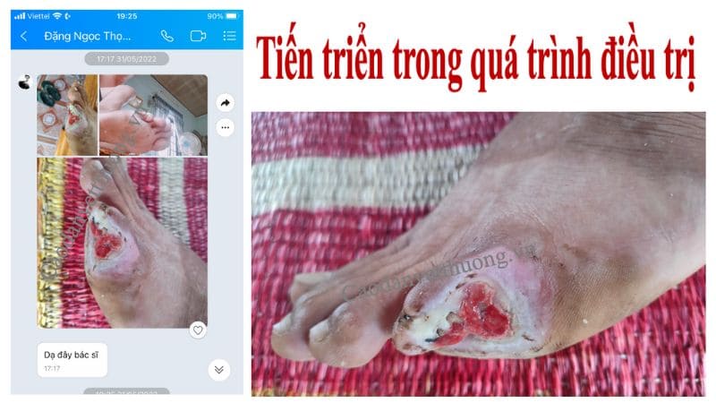 Dấu hiệu vết thương bị hoại tử