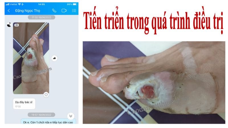 Hoại tử chân ở người già