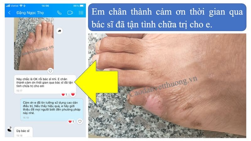 Hoại tử chân có chữa được không