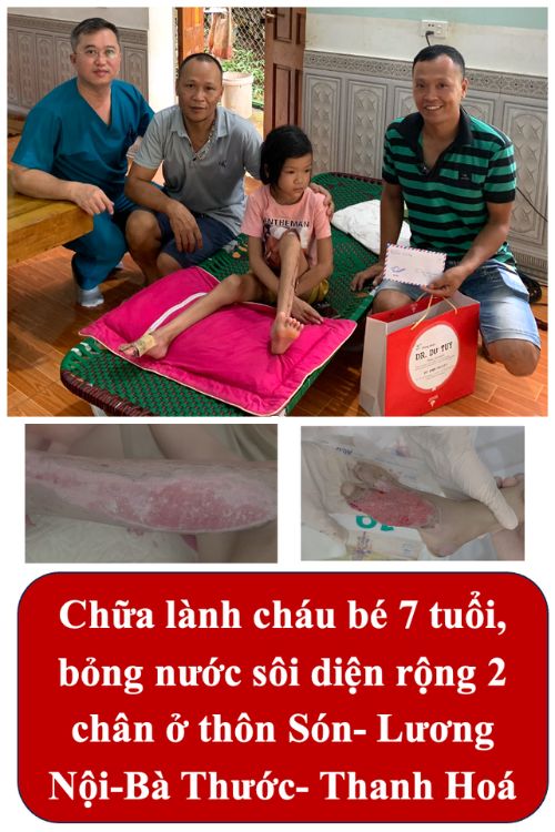 Bỏng nước sôi