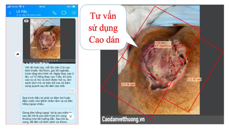 Thuốc bôi vết loét cho người liệt