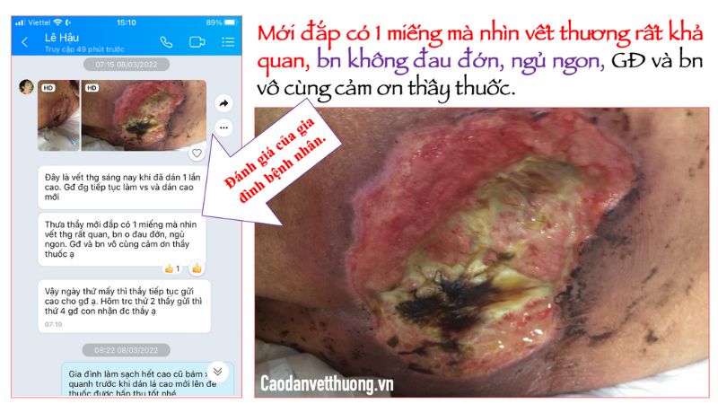 Một cây thuốc chữa loét da hay