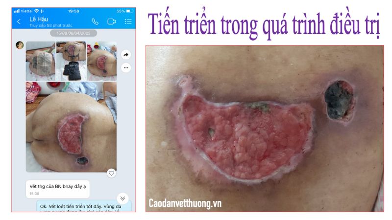 Cách trị lở loét da