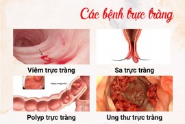 Các bệnh đại tràng phổ biến hiện nay