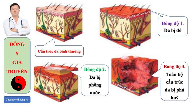 Các cấp độ bỏng