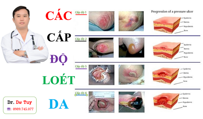 cac-cap-do-loet-da(5)