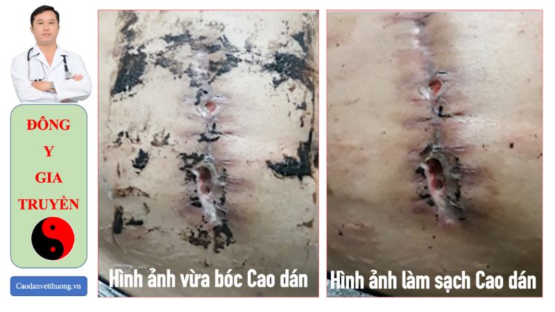 Cách chăm sóc vết thương hở