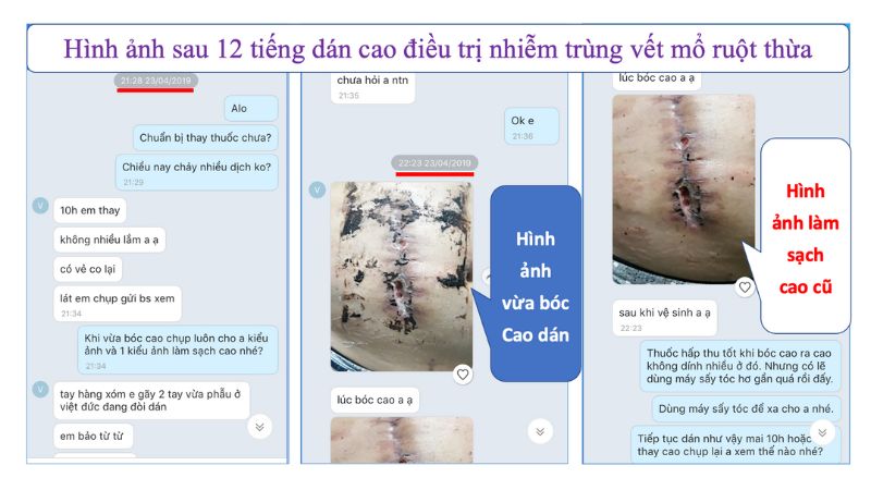 Cách chăm sóc vết thương khâu