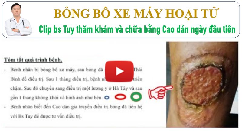 Cách chữa bỏng