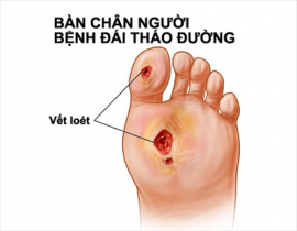 Cao dán chữa loét da cho người bị tiểu đường