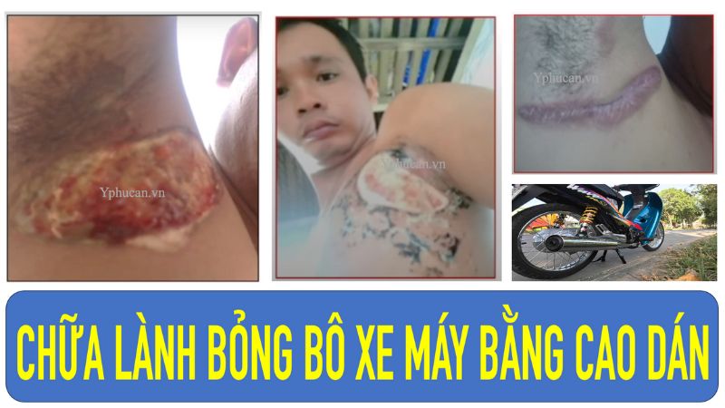 Chữa lành bỏng bô xe máy bằng Cao dán gia truyền