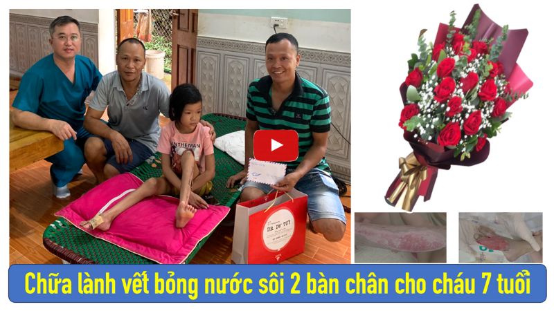 Cách trị bỏng