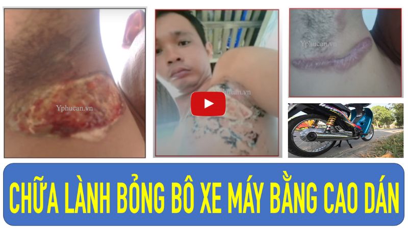 Cách trị bỏng tại nhà