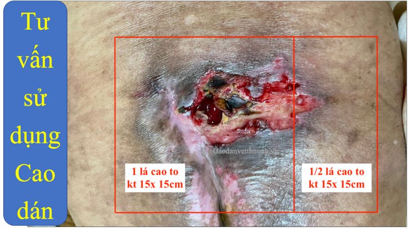 Cách chăm sóc vết loét xương cụt