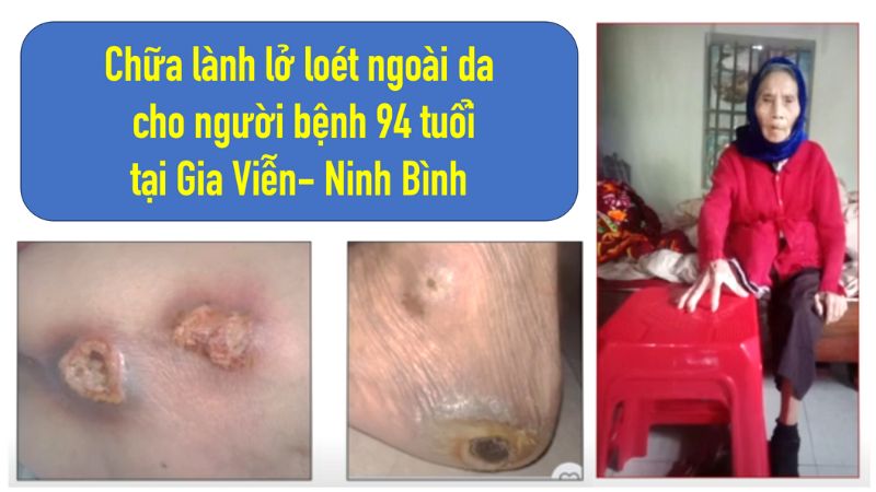 Chữa lành lở loét ngoài da cho người bệnh 94 tuổi tại Gia Viễn- Ninh Bình