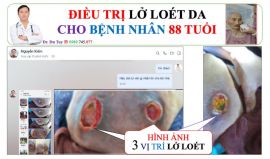 Chữa loét tì đè cho người già nằm liệt