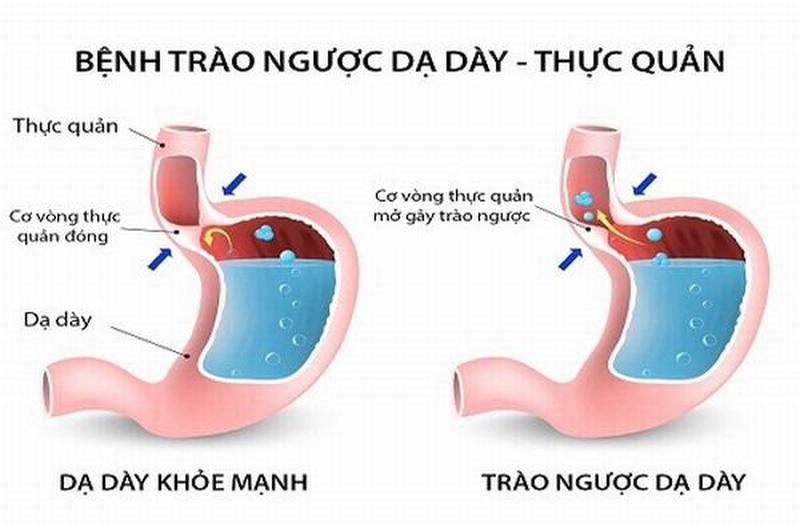 chua-trao-nguoc-da-day-bang-thuoc-dong-y-3