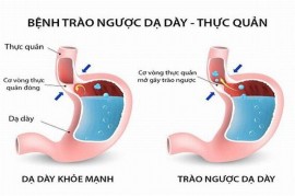 Điều trị trào ngược dạ dày hiệu quả - an toàn bằng thuốc Đông y