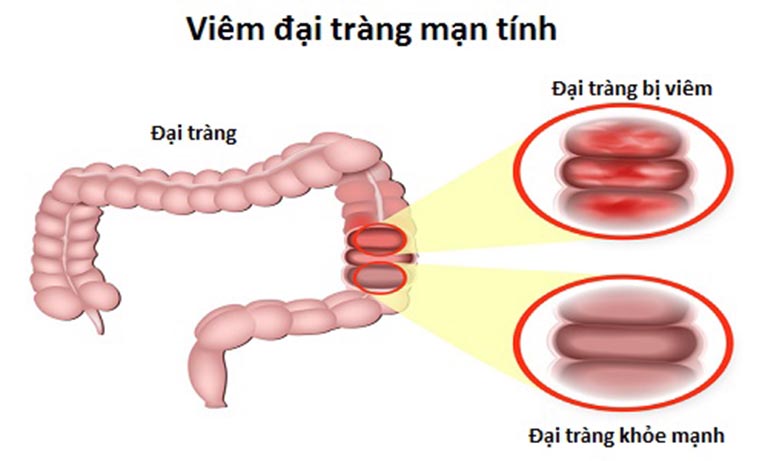 dieu-tri-benh-dau-dai-trang2