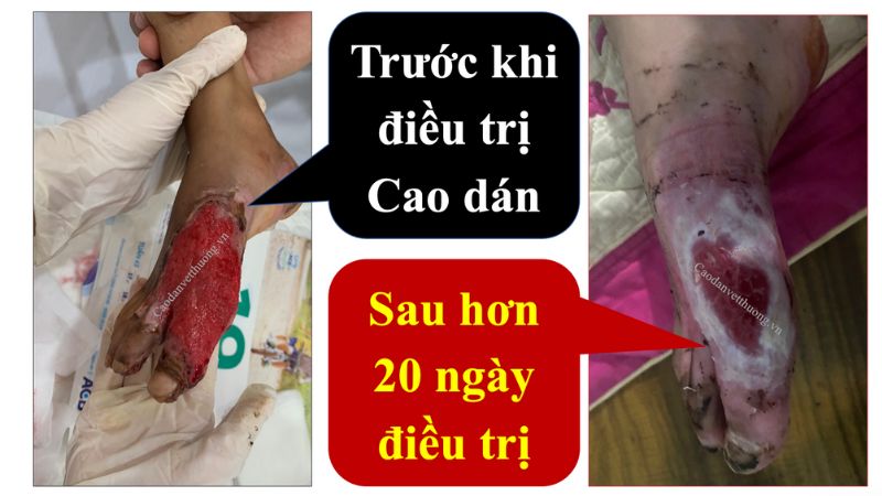 dieu-tri-bong-nuoc-soi-cho-chau-be-7-tuoi-bang-cao-dan-gia-truyen10