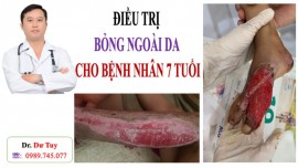 Điều trị Bỏng nước sôi cho cháu bé 7 tuổi bằng Cao dán gia truyền