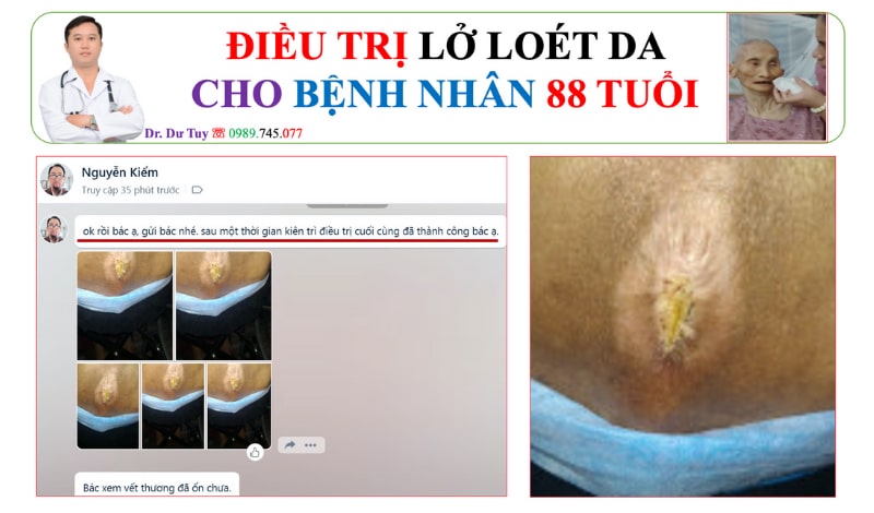 Loét do tỳ đè