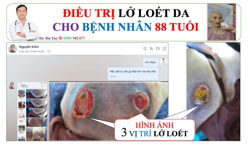 Loét da vùng cùng cụt