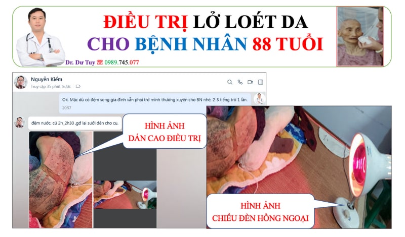 Lở loét da do tỳ đè