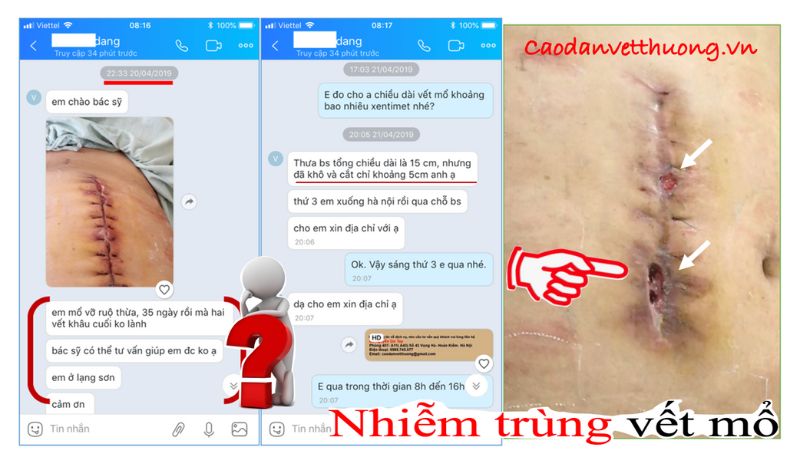 Hình ảnh nhiễm trùng vết mổ