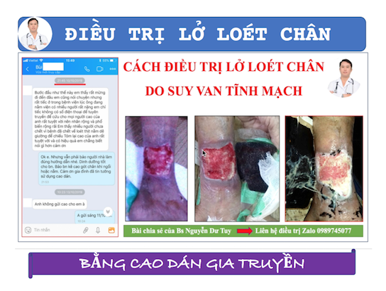 Lở loét cổ chân