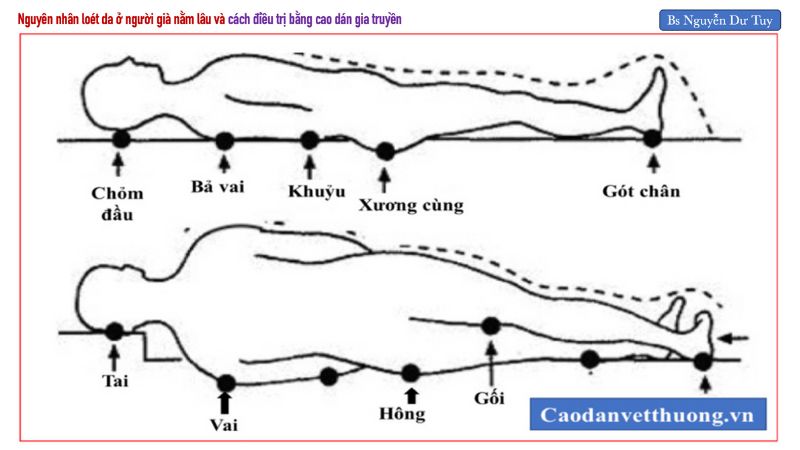 Lở loét da ở các điểm tỳ đè