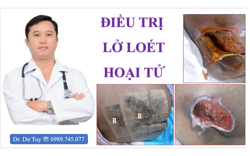 Điều trị lở loét hoại tử