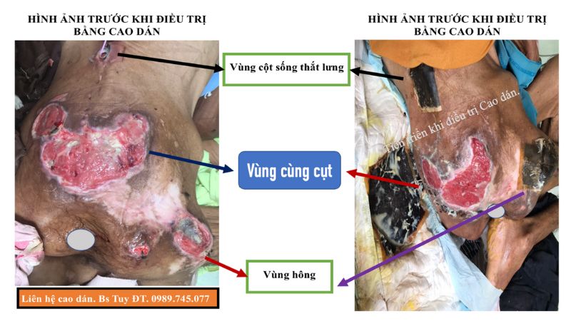 Lở loét khi nằm lâu 