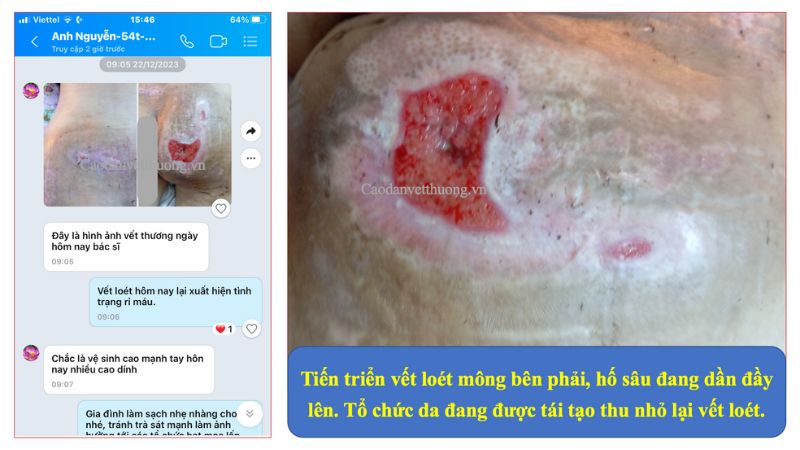 Trị vết loét cho người già