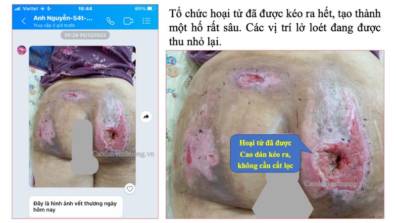 Thuốc bôi vết loét cho người liệt