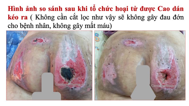 Thuốc trị lở loét cho người tiểu đường