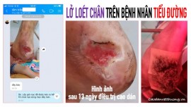 Loét chân do tiểu đường có chữa khỏi được không?