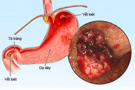 Loét dạ dày có nguy hiểm không?