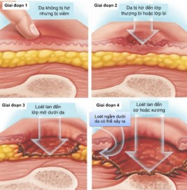 Loét do nằm lâu