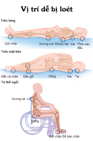 nhung-dieu-can-luu-y-khi-chua-tri-loet-da-ti-de