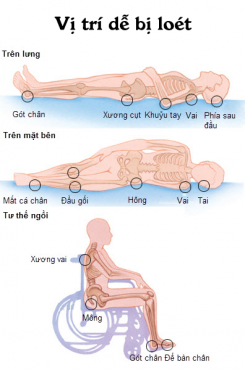 Những điều cần lưu ý khi chữa trị loét da tì đè 